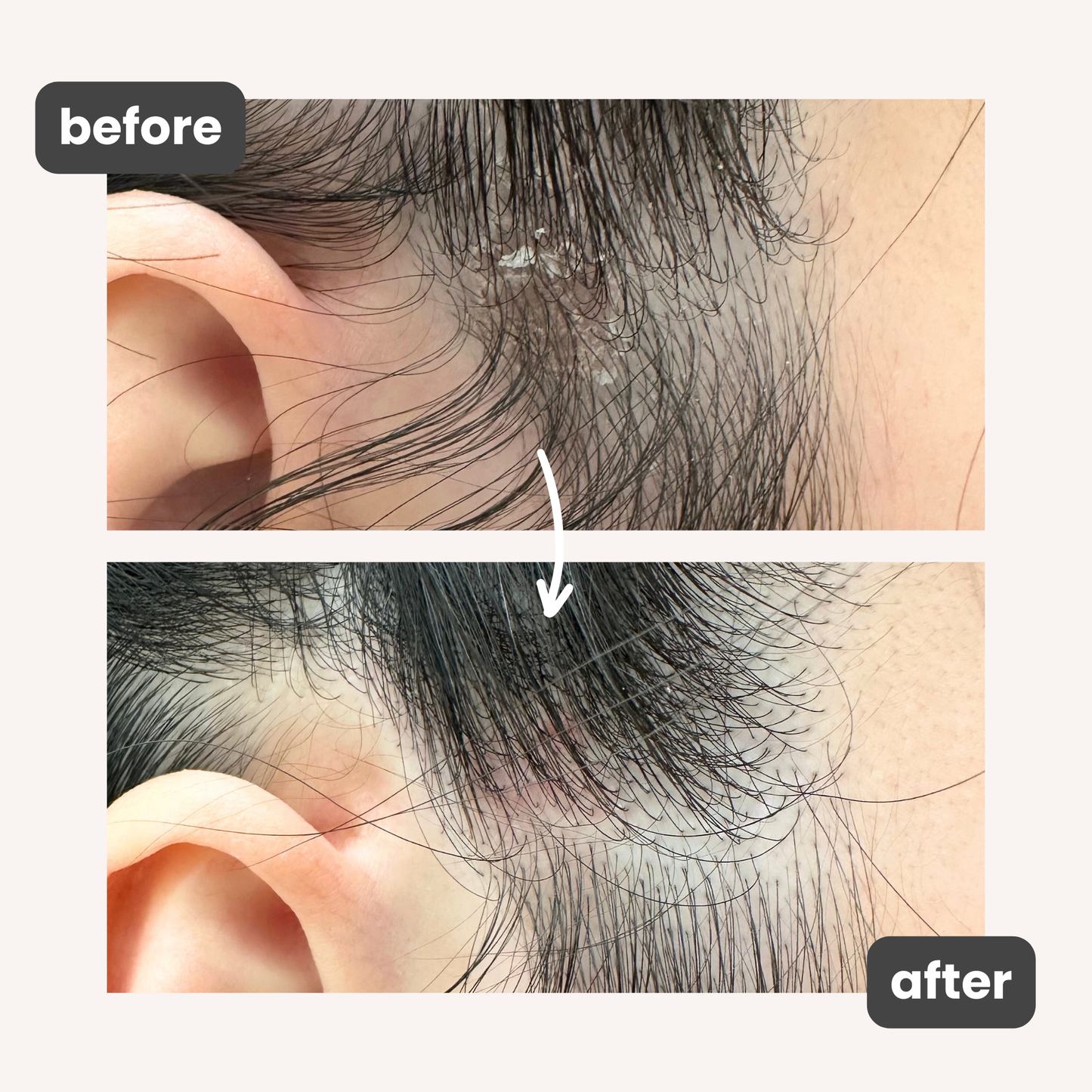 Soothing Scalp Mask for Psoriasis