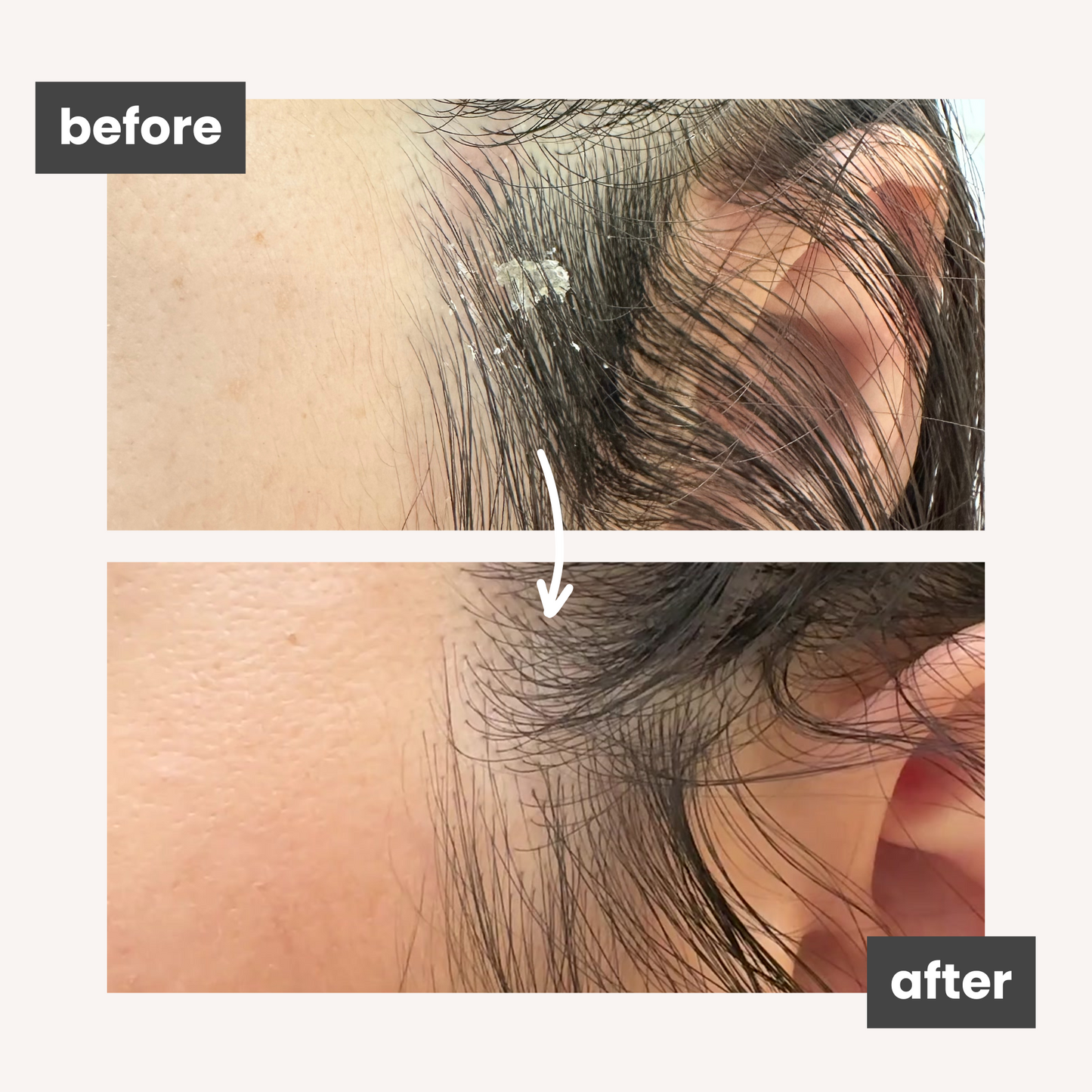 Soothing Scalp Mask for Psoriasis